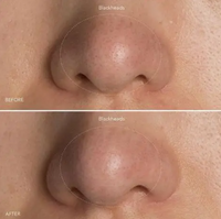 Foreo Kiwi Vacuum Device For Cleaning Pores